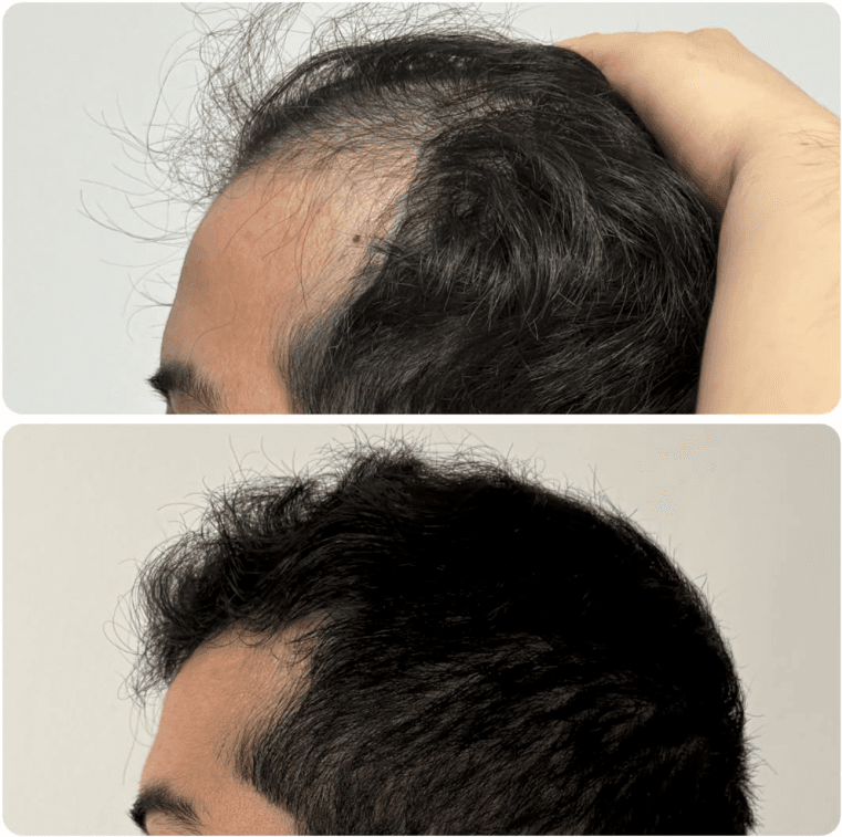Tratamiento capilar: antes y después